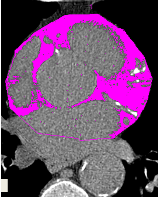 A CT scan of the heart