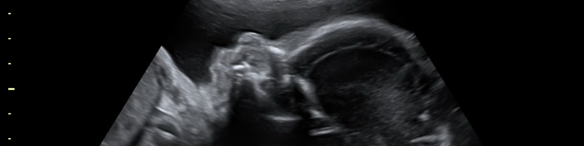 Ultrasound Image