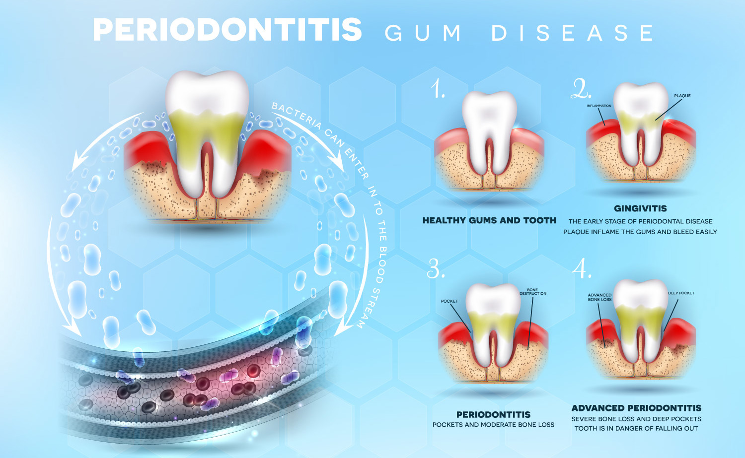 Periodontal disease vs gingivitis | Mike Petryk School of Dentistry